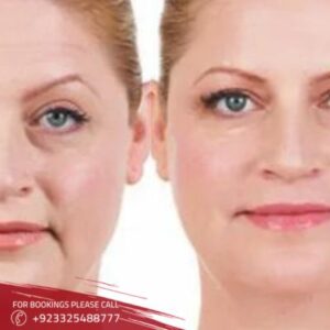 results of volite Fillers in Islamabad