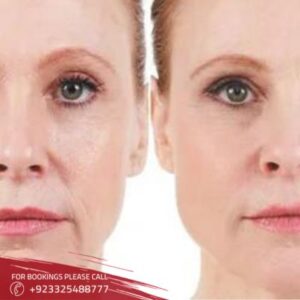 stem cell facelift in Islamabad