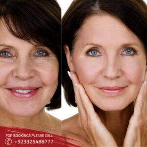 vampire face lift in Islamabad