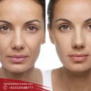 volite Fillers in Islamabad