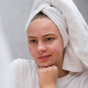 Acne Problem and Its Best Solution in Islamabad