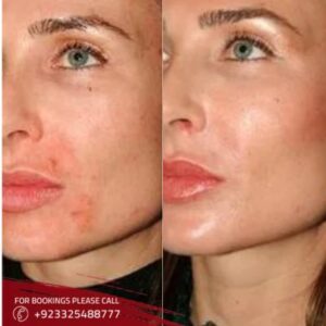 Burn Reconstructive Surgery in Islamabad