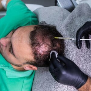 Can I Comb My Hair After PRP?