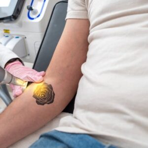 Can you completely remove a black tattoo?