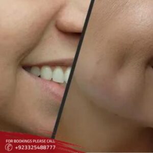Dimple Creation