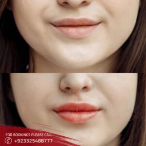 Dimple Creation treatment in Islamabad
