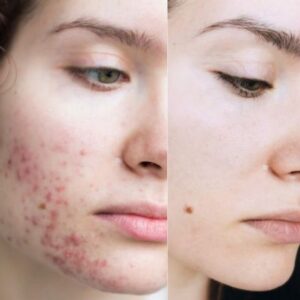 Does Skin whitening injection Heal Acne and Acne Scars?