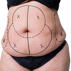 Does Liposuction Actually Remove Cellulite From Your Body?