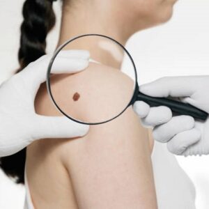 Effective Mole Removal Techniques In Islamabad