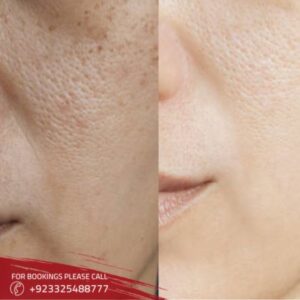Facial Treatments in Islamabad (1)