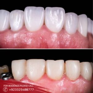 Gum Grafting