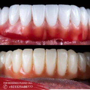 Gum Grafting images