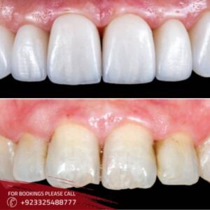 Gum Grafting in Islamabad