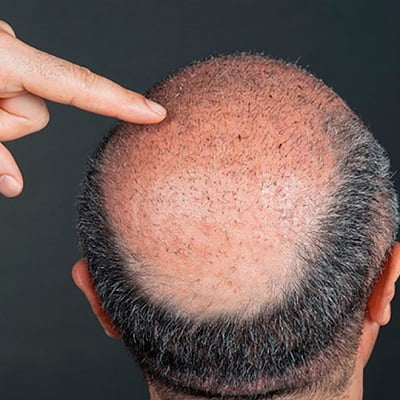 Hair Implants in Islamabad
