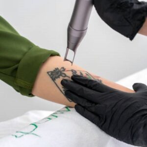 How Long Does Laser Tattoo Removal in Islamabad Take?