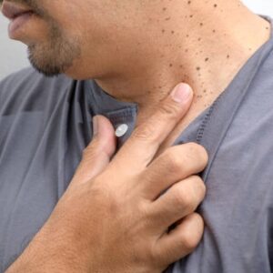 Time for a dermatologist to remove a skin tag