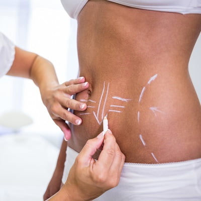 Is CoolSculpting is cheaper than liposuction in Islamabad