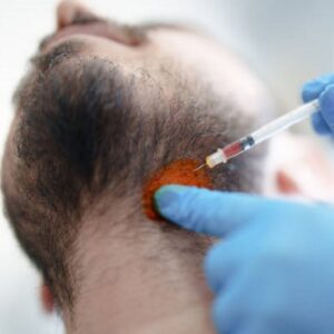 Is beard transplant in Islamabad is lifetime?