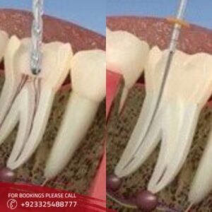 Root Canal Treatment 