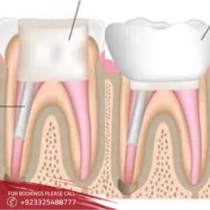 Root Canal in Islamabad