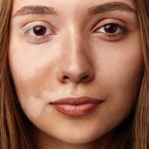 Latest treatment for skin pigmentation