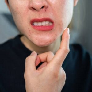 Permanent treatment for acne in Islamabad