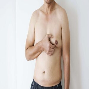 Who is the best doctor for gynecomastia in Islamabad?