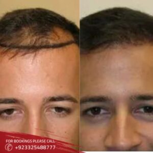 hair restoration (1)