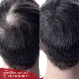 hair restoration treatment