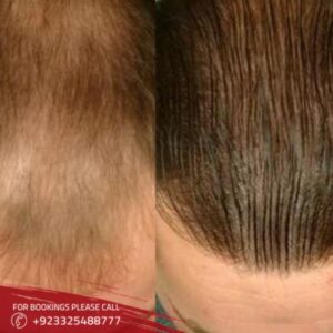 hair restoration treatment in Islamabad