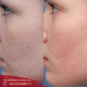 large pores treatment