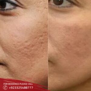 large pores treatment in Islamabad