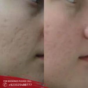 large pores treatment in Islamabad image
