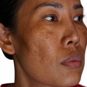 Exploring Skin Pigmentation Solutions in Islamabad