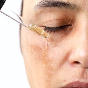 How to fade hyperpigmentation fast?