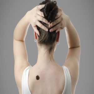 How to remove birthmarks permanently in Islamabad?