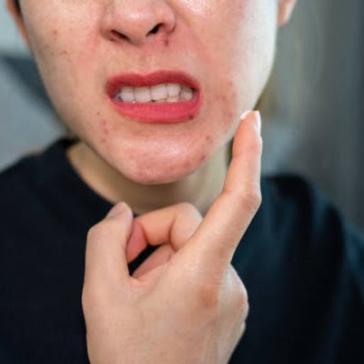 Top 5 Acne Treatments Available in Islamabad