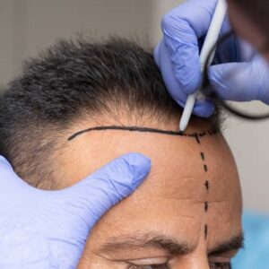 What Are the Latest Hair Transplant Options in Islamabad?