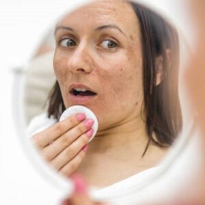 What Is the Best Treatment Plan in Islamabad For Melasma?