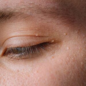 What Is the Least Painful Way to Get Rid of a Skin Tag?