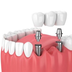 What is a negative about dental implants?
