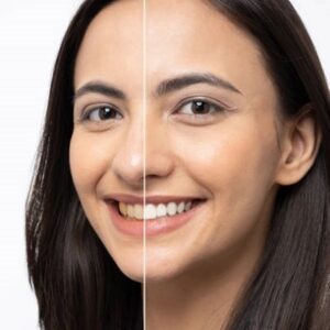 What is better: laser or gel teeth whitening?