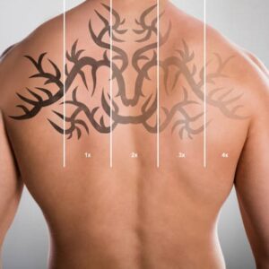 Which laser is best in Islamabad for tattoo removal?