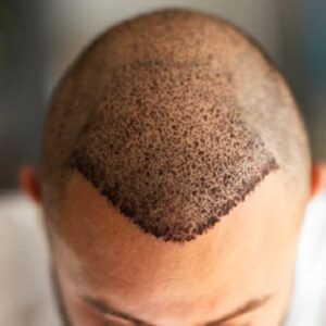 Whose hair is used in hair transplant?