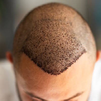 Whose hair is used in hair transplant?