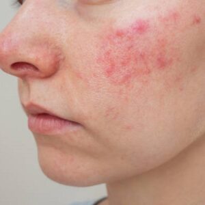 Can Botox be used to treat rosacea?
