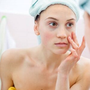 Can Eyebags go away permanently?