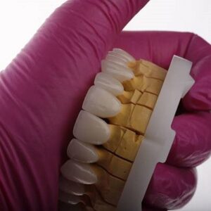 Do teeth rot under non-prep veneers?