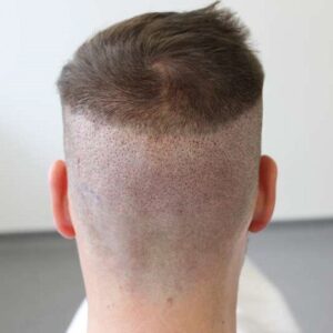 Does hair from a transplant fall out?