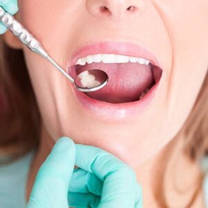 How Long Do Fillings Last?